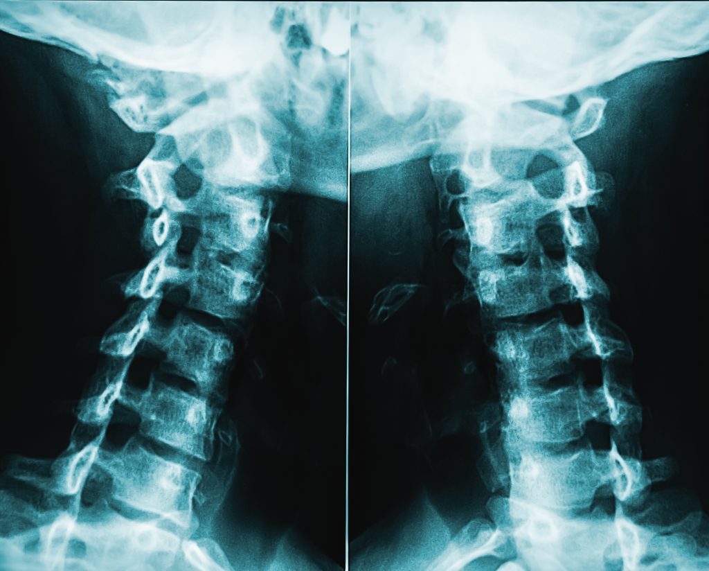Whelp Injury What is a Whiplash injury and how is it treated? | Willow Wellness